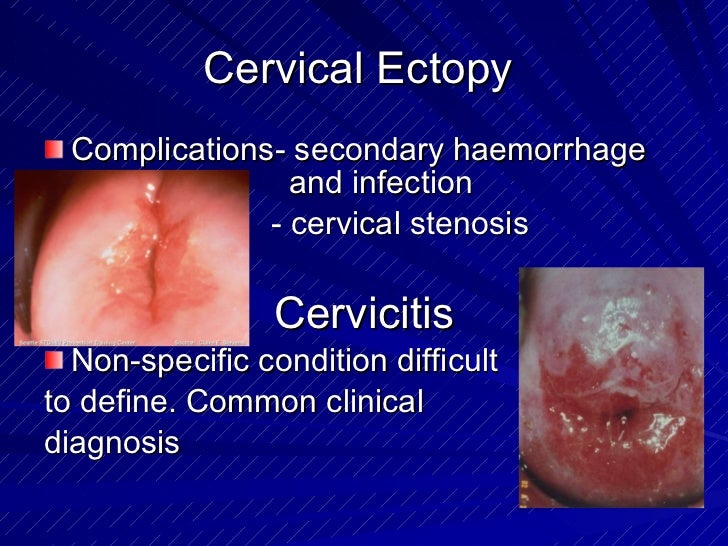 lesions on vulva Lesions on vulva